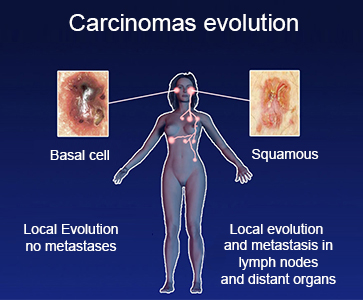 Carcinomas-Evolution